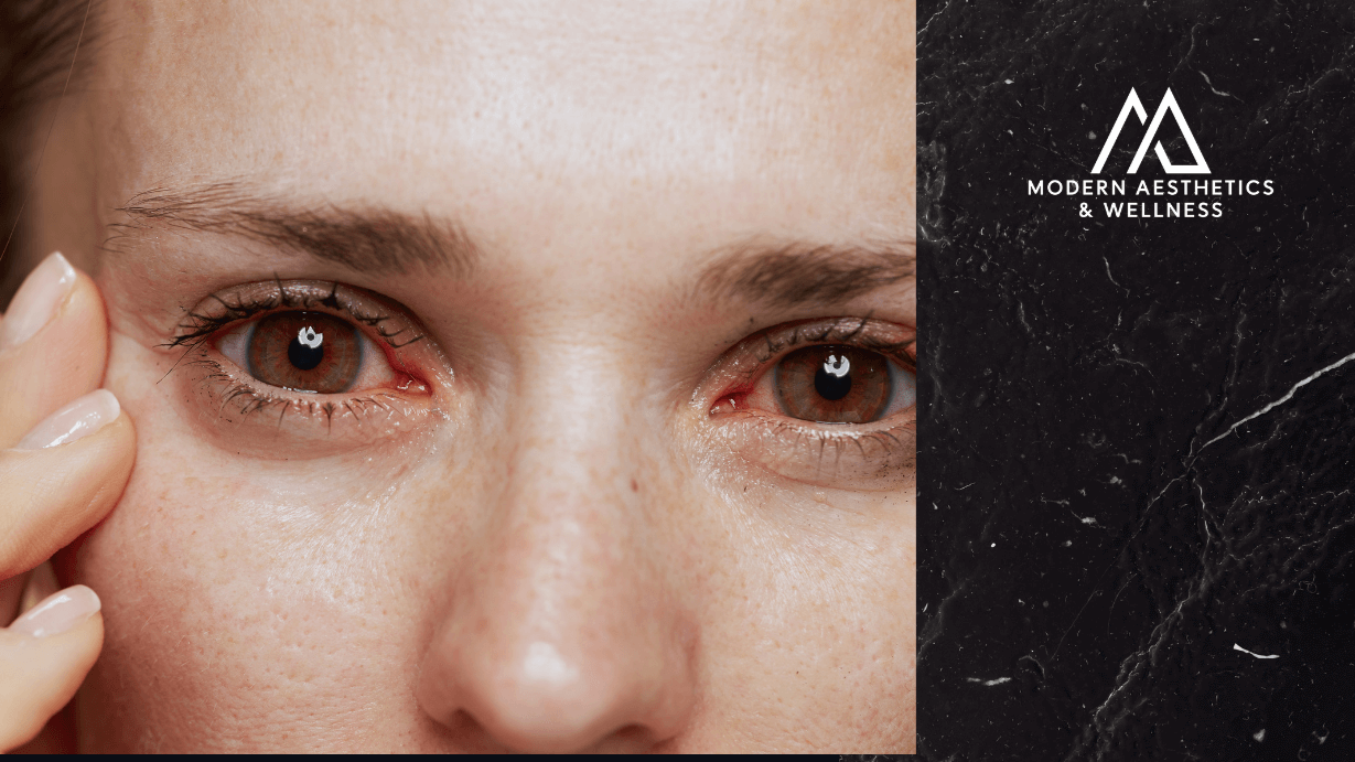 does tirzepatide cause dry eyes How Tixel Helps Improve Dry Eye Symptoms